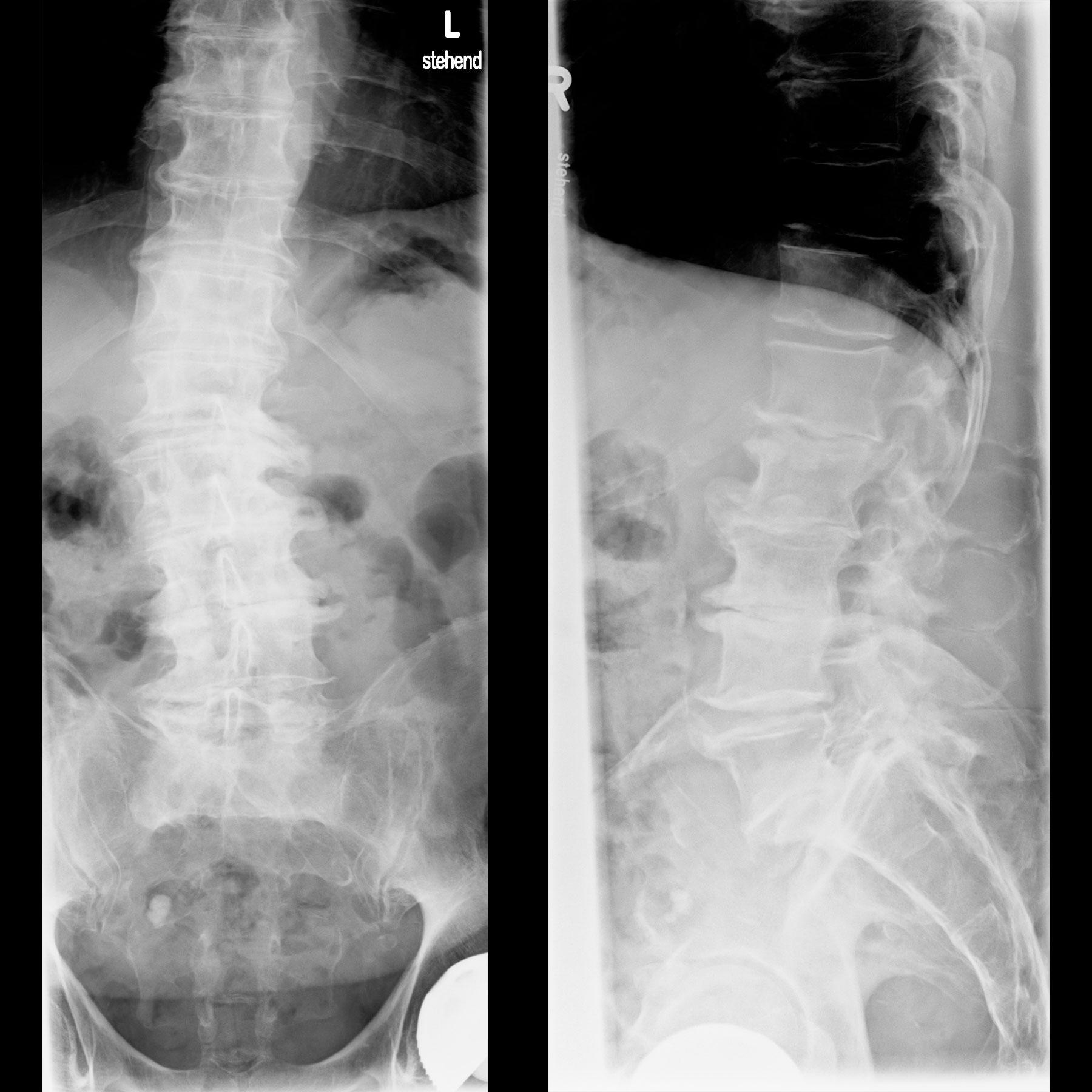 Bild 8/44 - Röntgen: Chron. Rückenschmerzen, 79-j. Mann