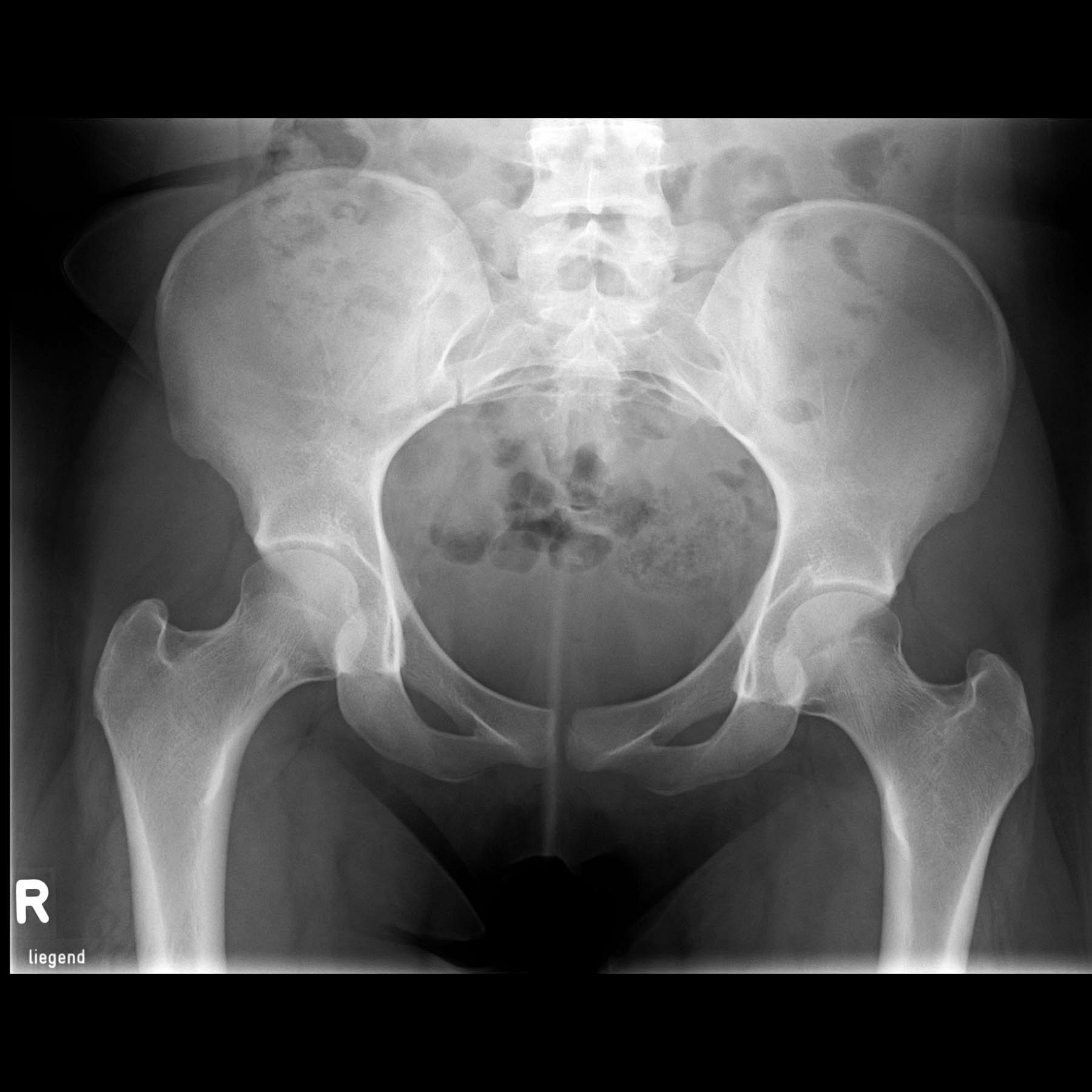 Bild 1/7 - Röntgen: Beckenübersicht ap einer Frau