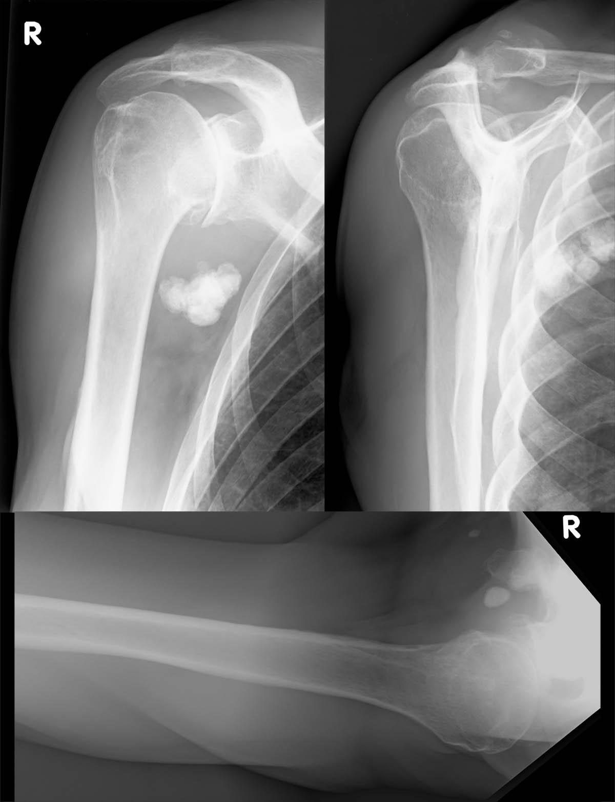 Λ Bild 19/44 - Röntgen: Impingementsymptomatik, 72-j. Mann Λ