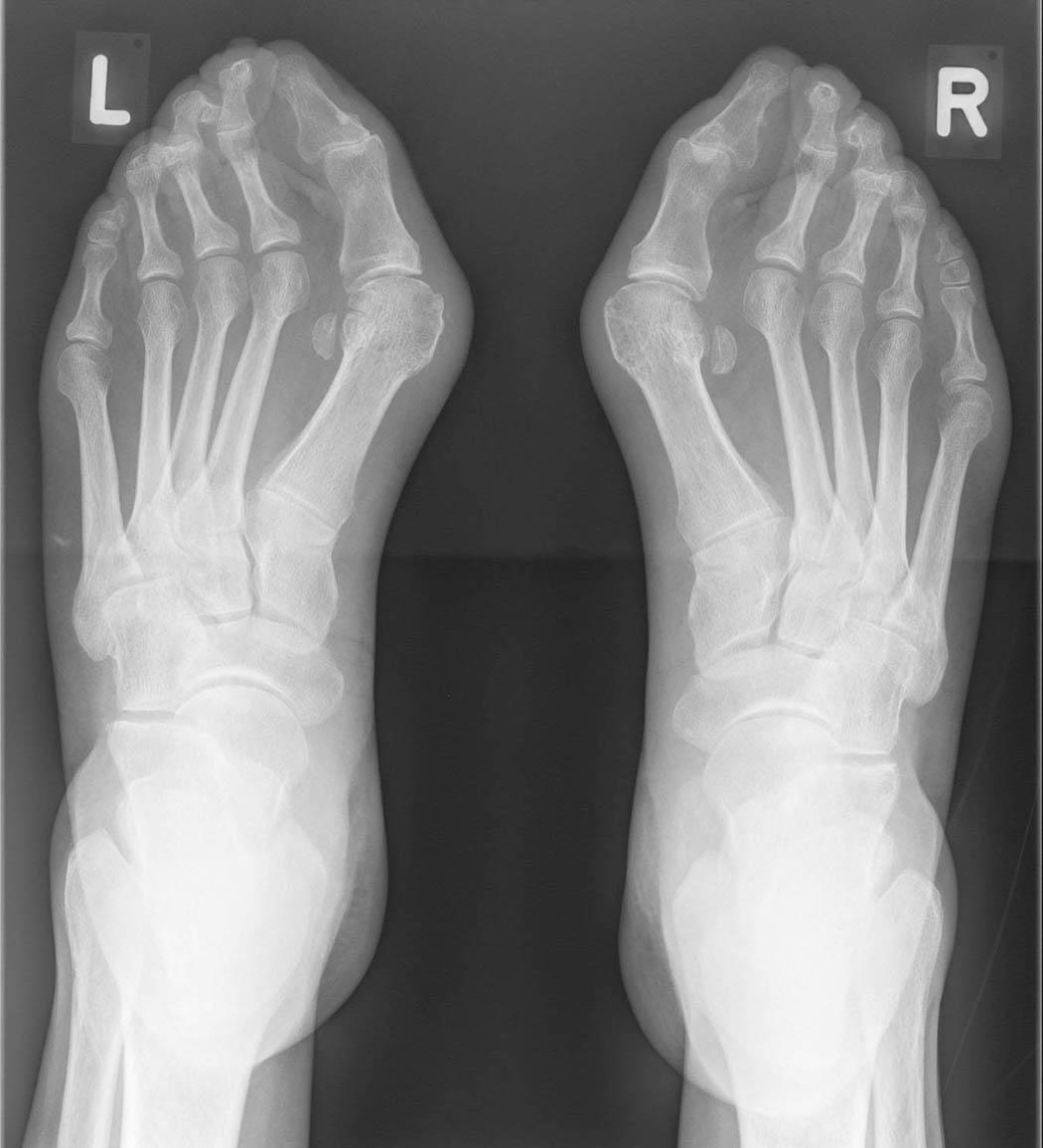 Bild R Ntgen Rheumatoide Arthritis J Frau