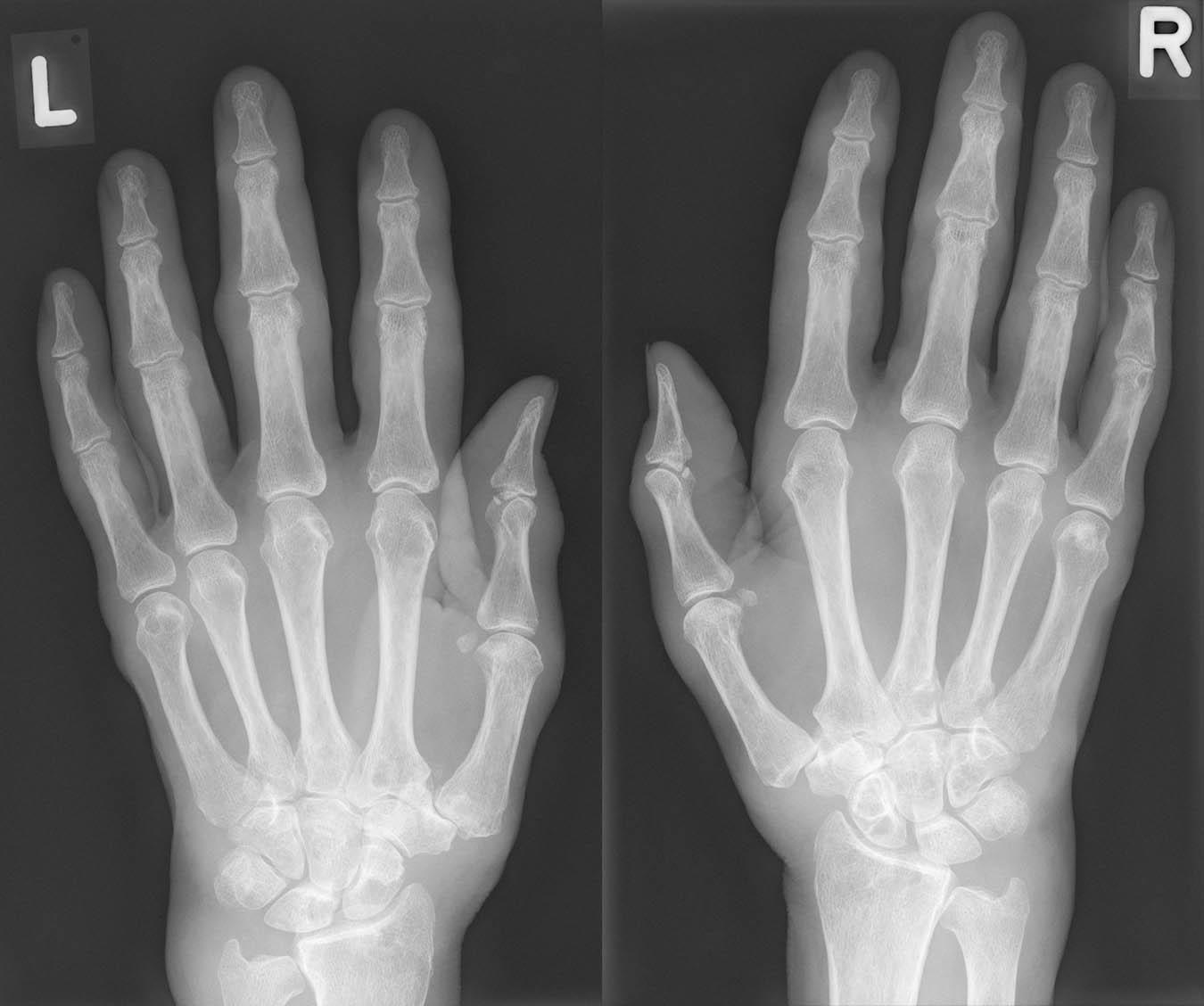 Λ Bild 16 43 Röntgen Rheumatoide Arthritis 67 j Frau Λ