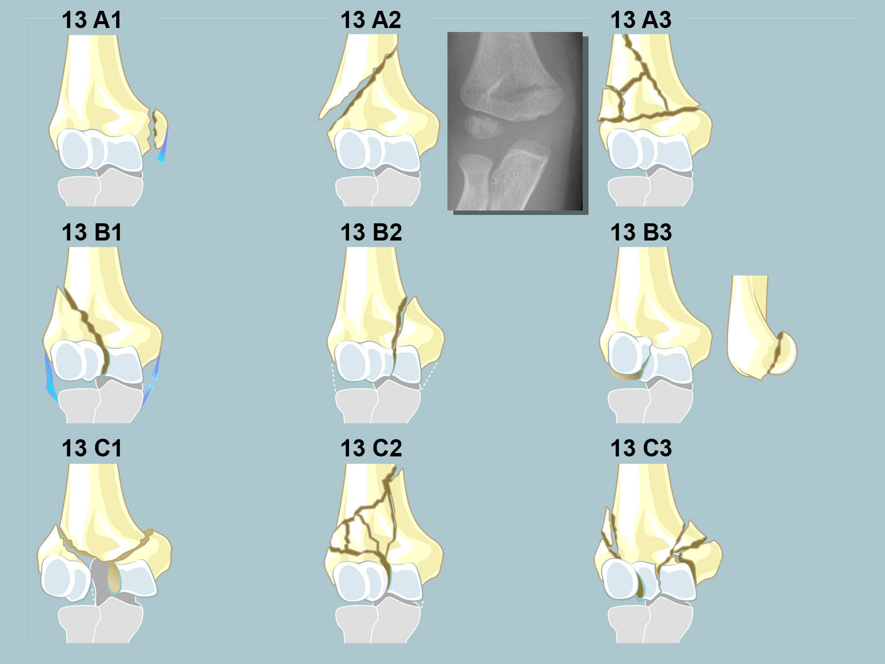 Grad Der Behinderung Bei Humerusfraktur radiosurf.elearning.aum.iml.unibe.ch