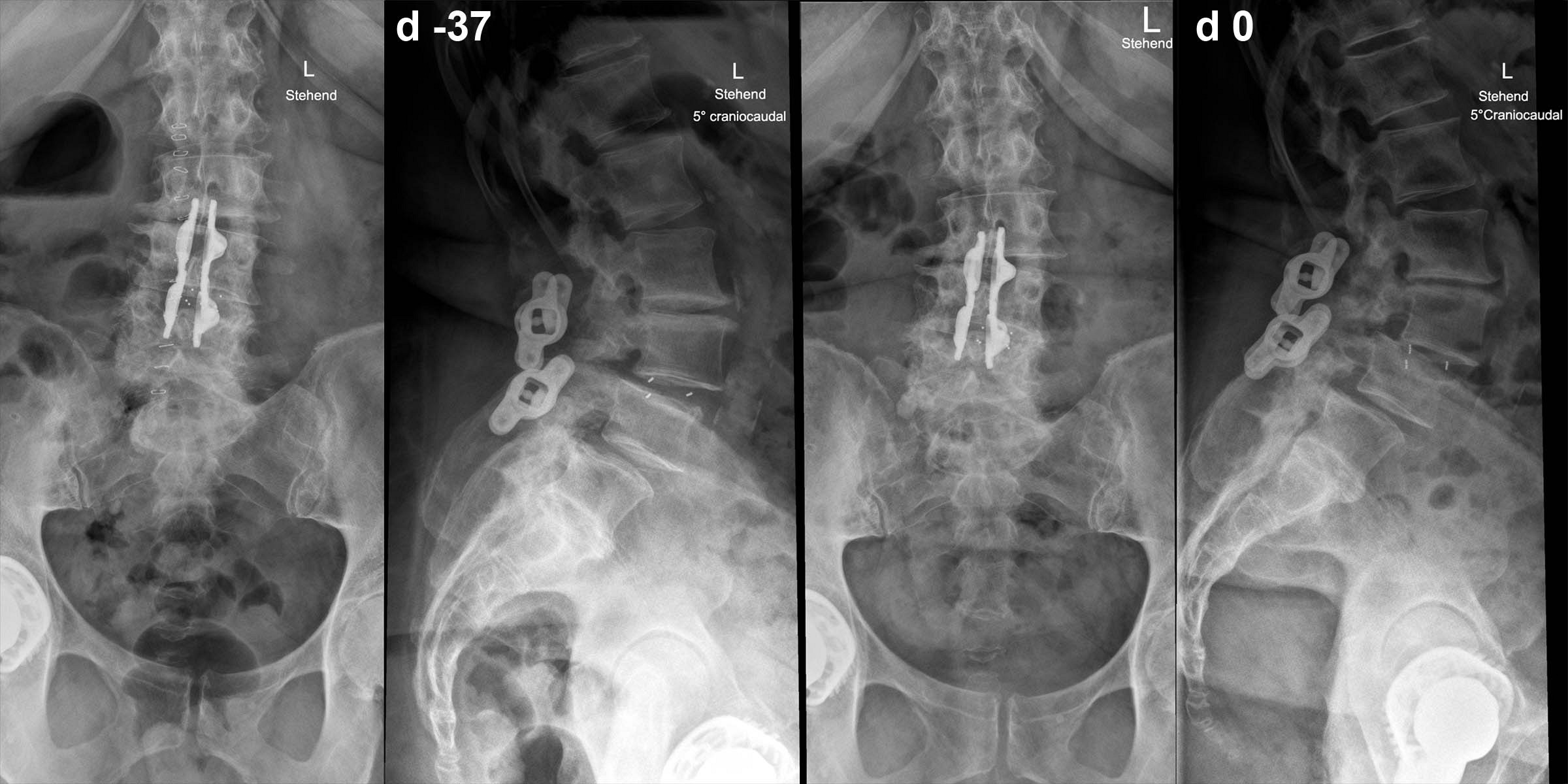 Bild 38/44 - Röntgen: Erneute Rückenschmerzen, 76-j. Frau