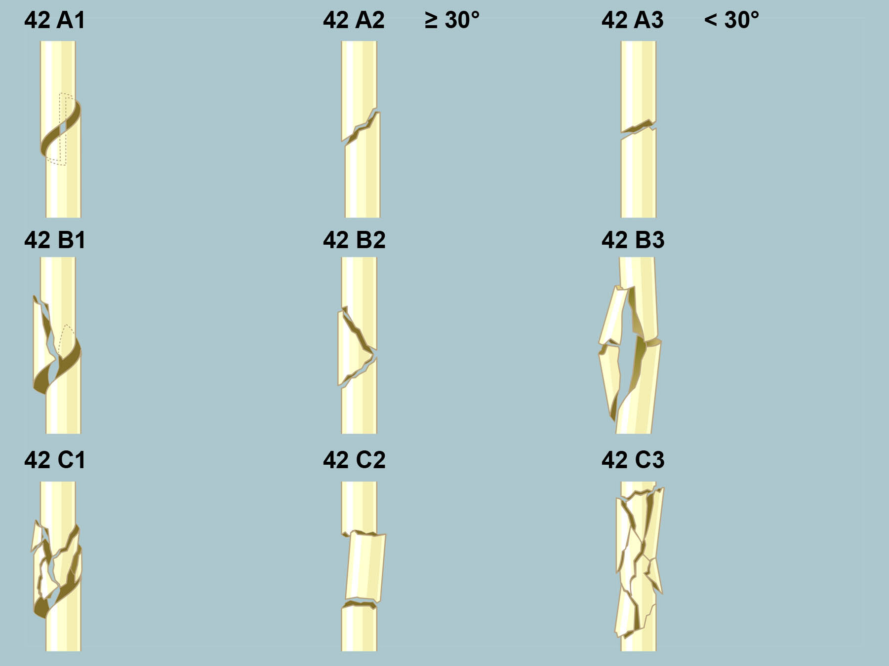 Λ Bild 38 42 Grafik Tibiaschaftfrakturen Λ