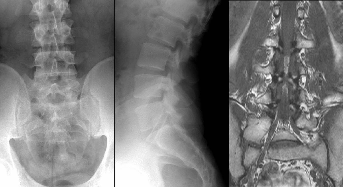 Bild 6/28 - Röntgen: Lumbale Rückenschmerzen