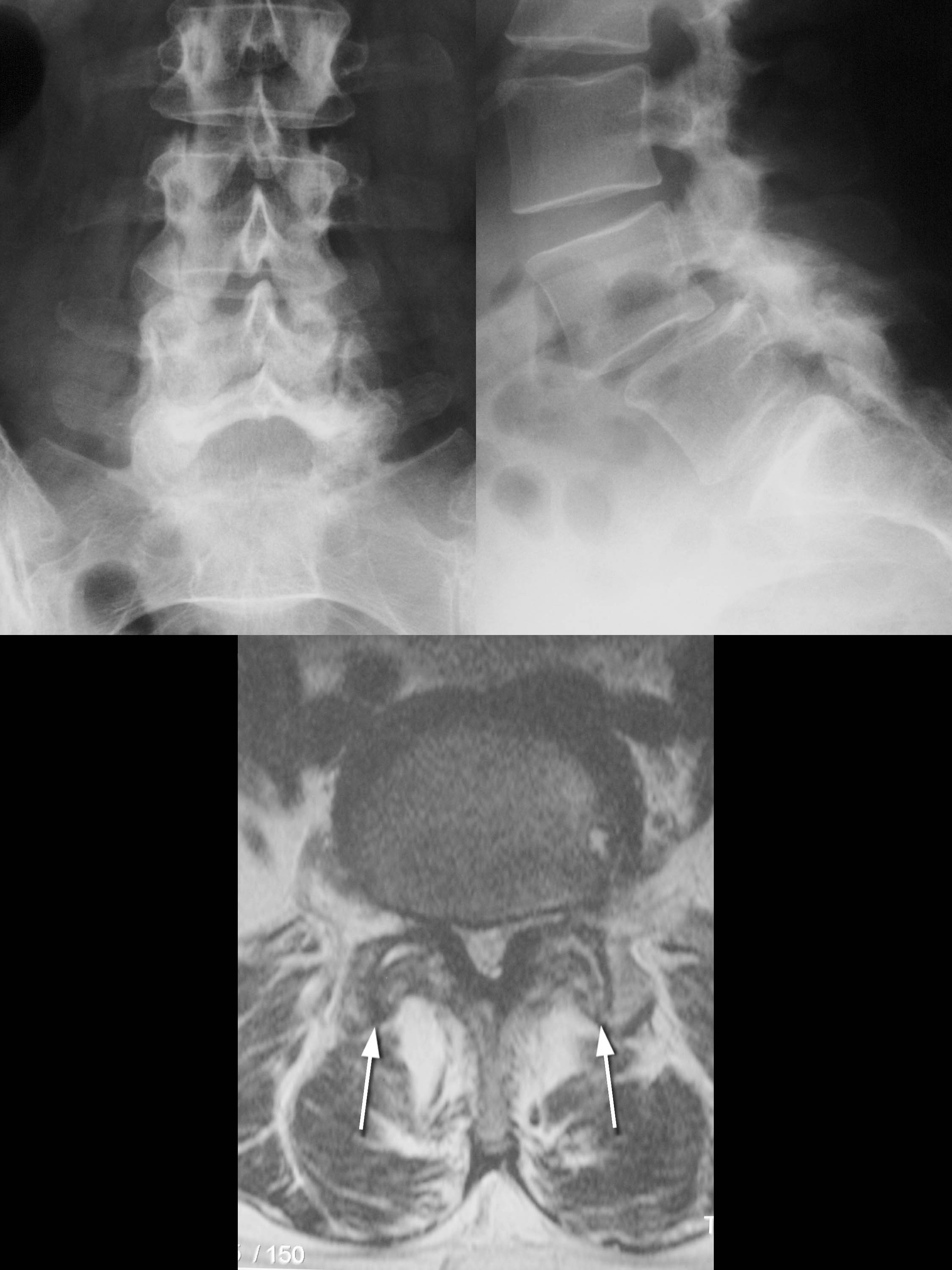 Λ Bild 25/46 Röntgen Chronische Rückenschmerzen und Claudicatio