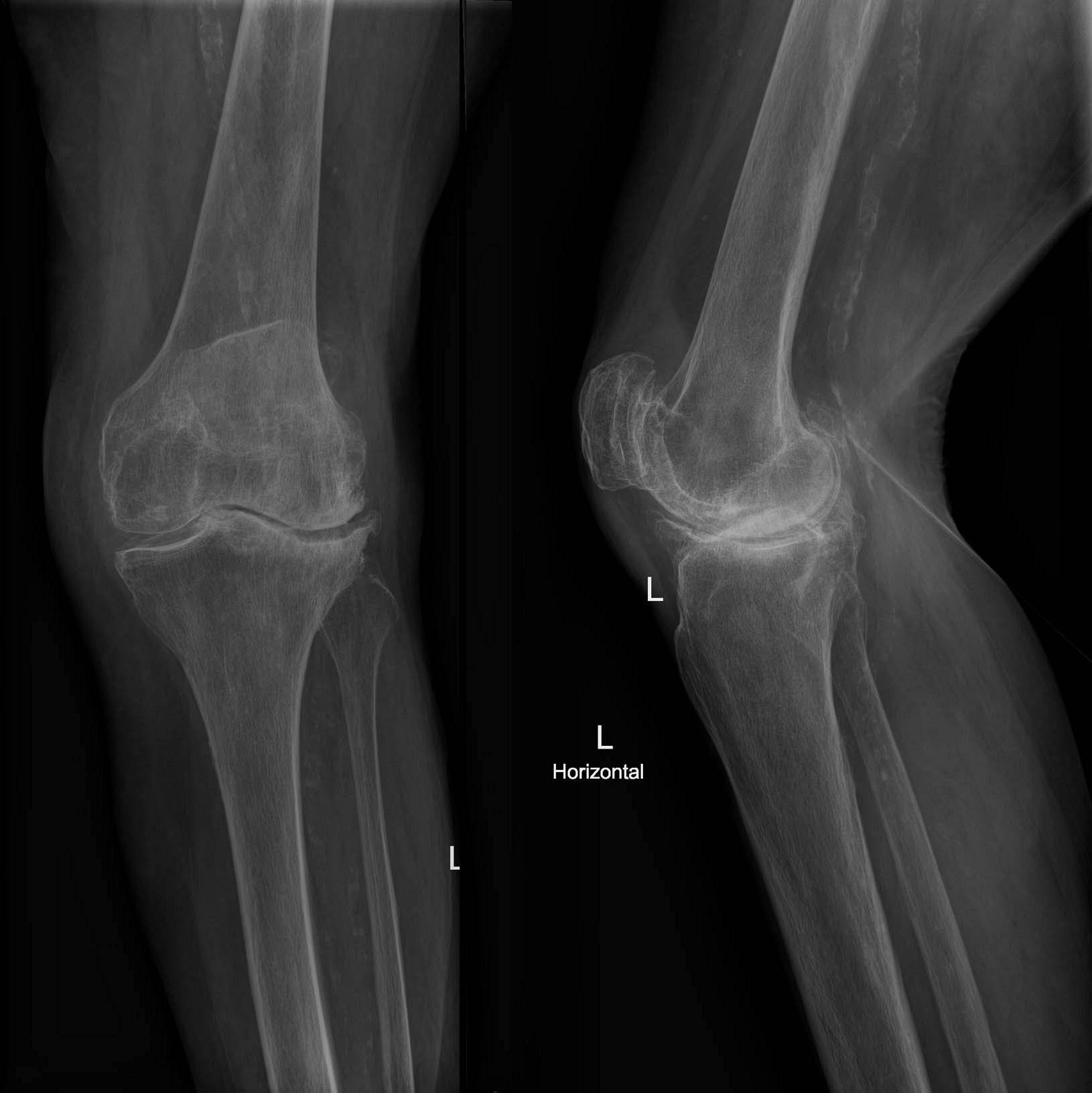 bild-55-61-r-ntgen-chron-knieschmerzen-links-82-j-frau
