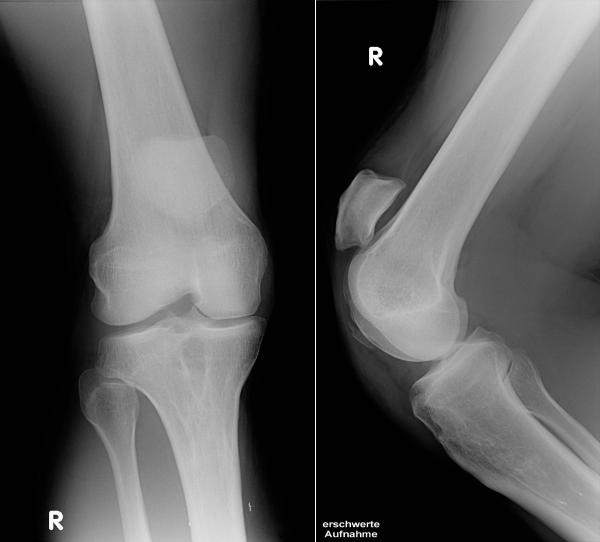 Röntgen Knie