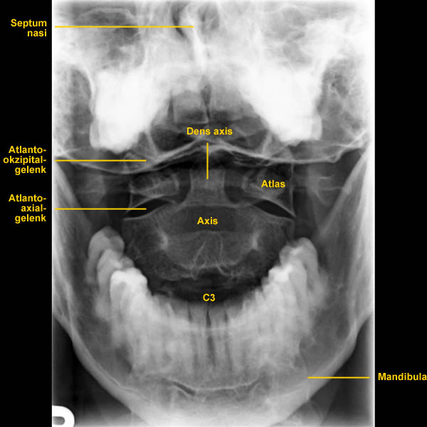 Bild 4/4 - Röntgen: Atlas mit Dens ap