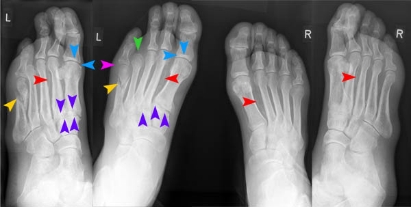 Fuss dp/schräg rechts d1