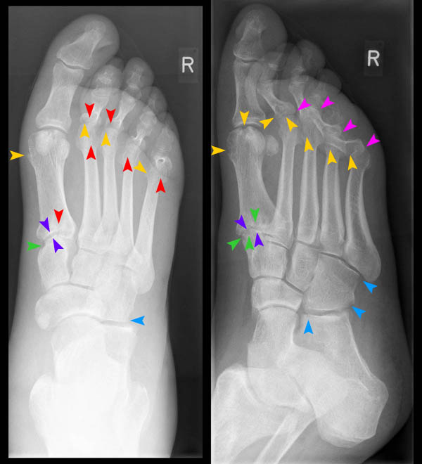 Fuss dp/schräg rechts d1