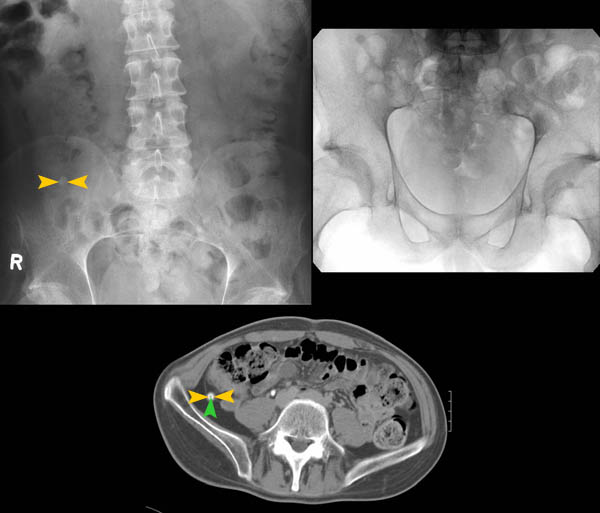 Bild 35/46 Röntgen Zufallsbefund