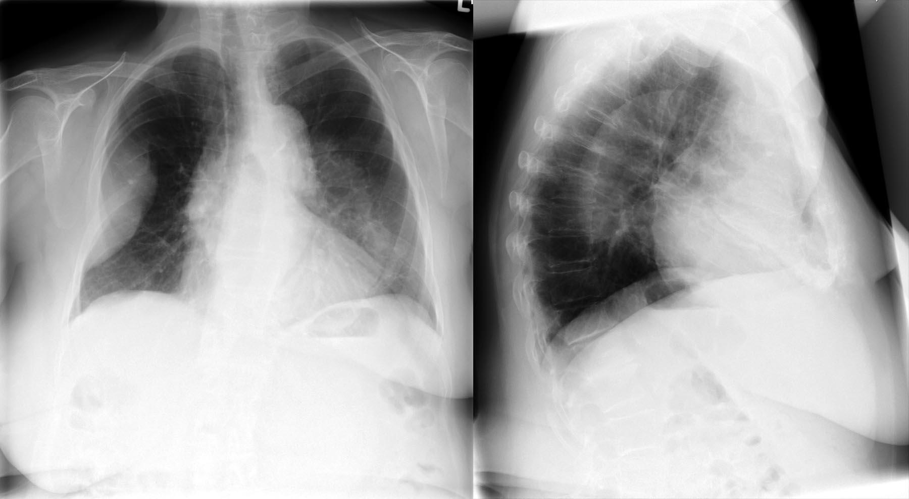 Bild 2/19 - Thorax pa/seitl.: Unklare Schwellung, 81-j. Frau