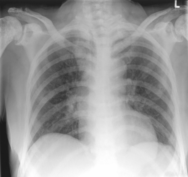 Thorax Ap Liegend | Schritt für Schritt zur Röntgen-Thorax-Befundung ...