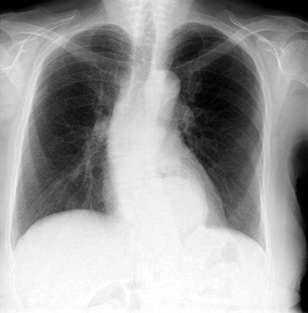beurteilung hiatushernie im mittleren mediastinum ansonsten zeigt sich