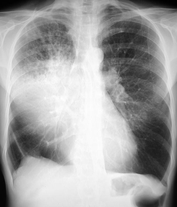 post stenotischen pneumonien die sich im röntgen eher als flächige ...