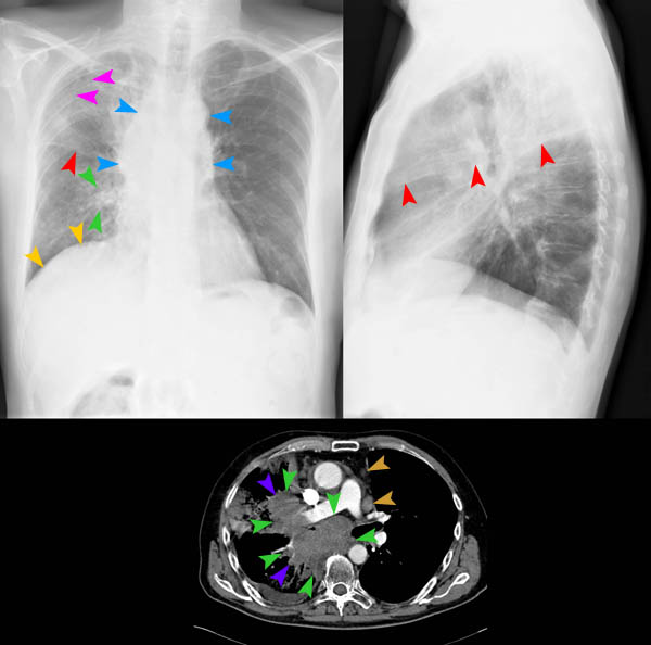 Bild 8/60 - Thorax pa/seitl. + CT: Chron. Husten mit AZ ...