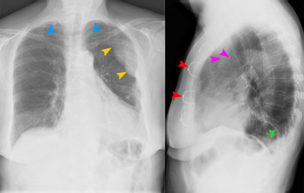 Bild 27/68 Thorax pa/seitl. Verlaufsuntersuchung bei St. n. ACBP
