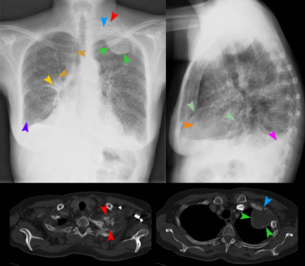Bild 33/60 - Thorax pa/seitl. + CT: Dyspnoe + retrosternale Schmerzen ...