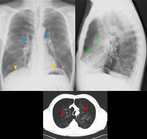 Bild 36/68 Thorax pa/seitl. + CT Progred. Anstrengungsdyspnoe bei